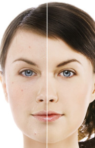 Rosacea