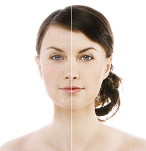 Rosacea Treat at 207 Laser - formerly Maine Laser Clinic