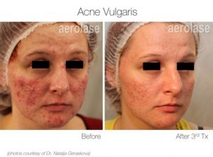 Acne treatment before and after