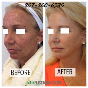 Juvederm