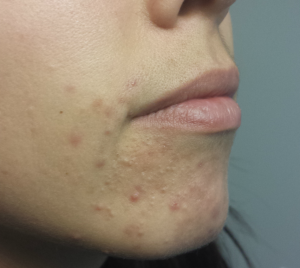 Ance Treatment