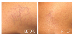 Spider Vein pre-post