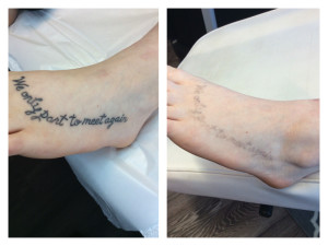 Tattoo removal after 5 sessions, 1 to go