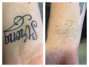 Tattoo removal after 5 sessions, 1 to go