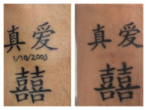 Tattoo removal Before and after photo