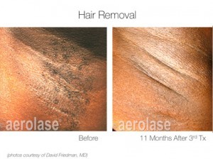 laser hair removal