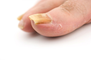 Nail Fungus