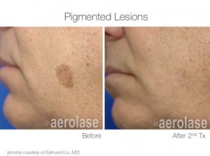 Pigmented lesion before and after