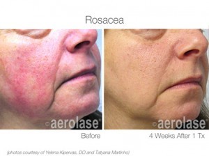 Rosacea before and after treatment