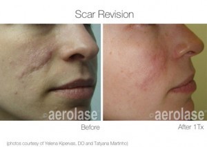 Scar revision before and after