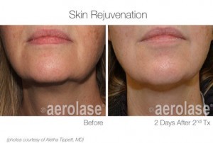 Skin Rejuvenation
