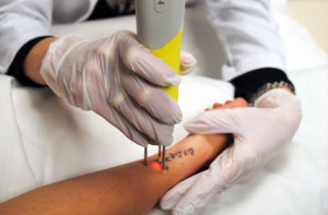 Tattoo Removal