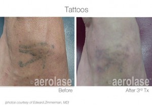 Tattoo removal