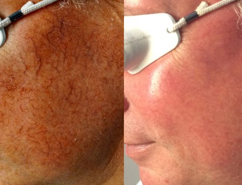 Banish Spider Veins: Effective Treatment Options Unveiled