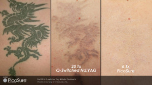 Tattoo removal