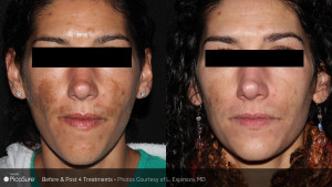 Skin Tightening
