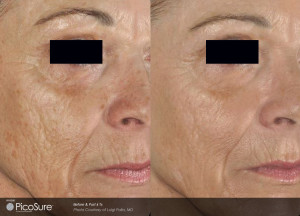 non surgical face lift