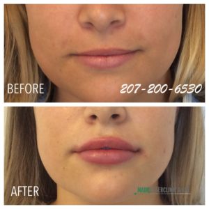 Juvederm
