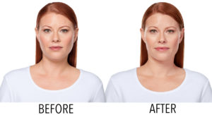 KYBELLA®