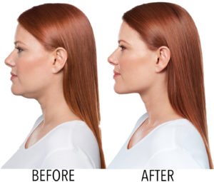 Kybella before and after