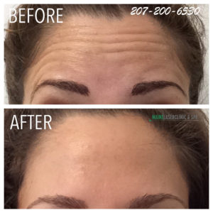 Botox®