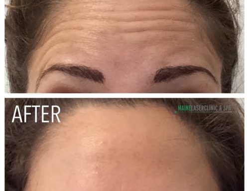 What kind of results can I expect from Botox®?
