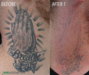 Before and after