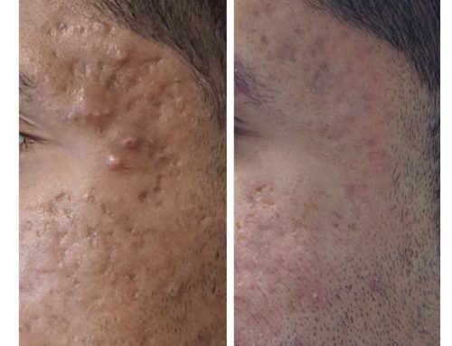 Microneedling Magic: Unleashing Your Skin’s Innate Radiance