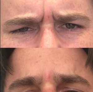 Male botox