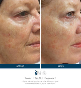 Microneedling