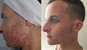 Before & after acne treatment