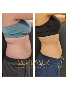 truSculpt iD