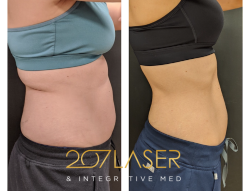 Discover Body Contouring at 207 Laser Maine