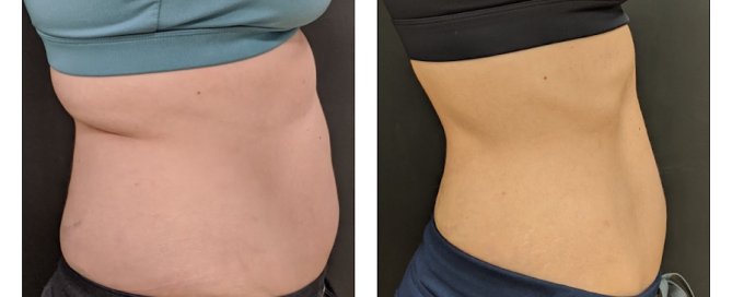 truSculpt iD