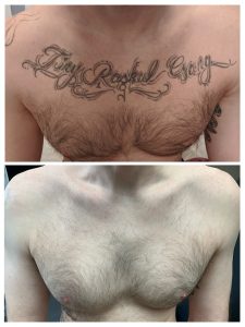 tattoo removal