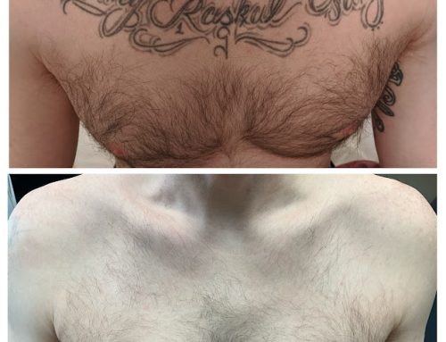 Maine’s Outstanding Tattoo Removal Technology: Your Expert Guide