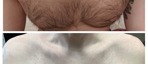 tattoo removal