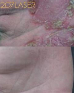 Psoriasis