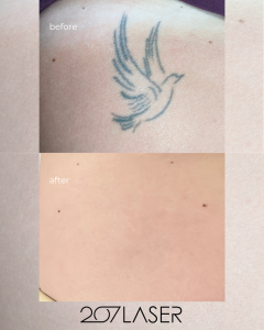 Before and after PicoSure picosecond laser tattoo removal results at 207 Laser showing complete ink clearance.