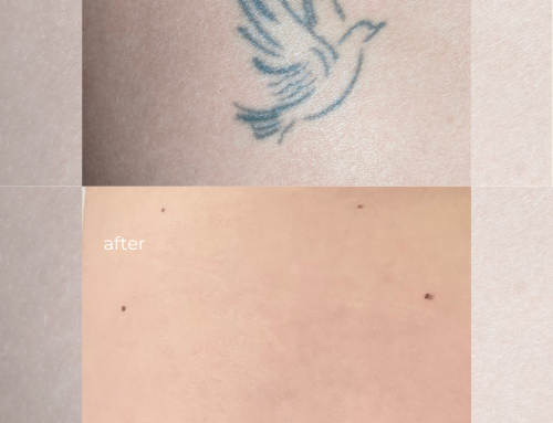 The Science of Picosecond Laser Tattoo Removal: Why PicoSure Outperforms Legacy Lasers
