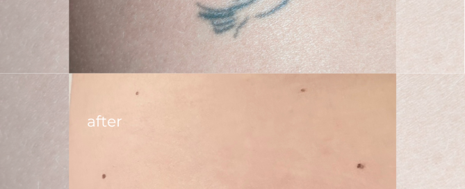 Before and after PicoSure picosecond laser tattoo removal results at 207 Laser showing complete ink clearance.